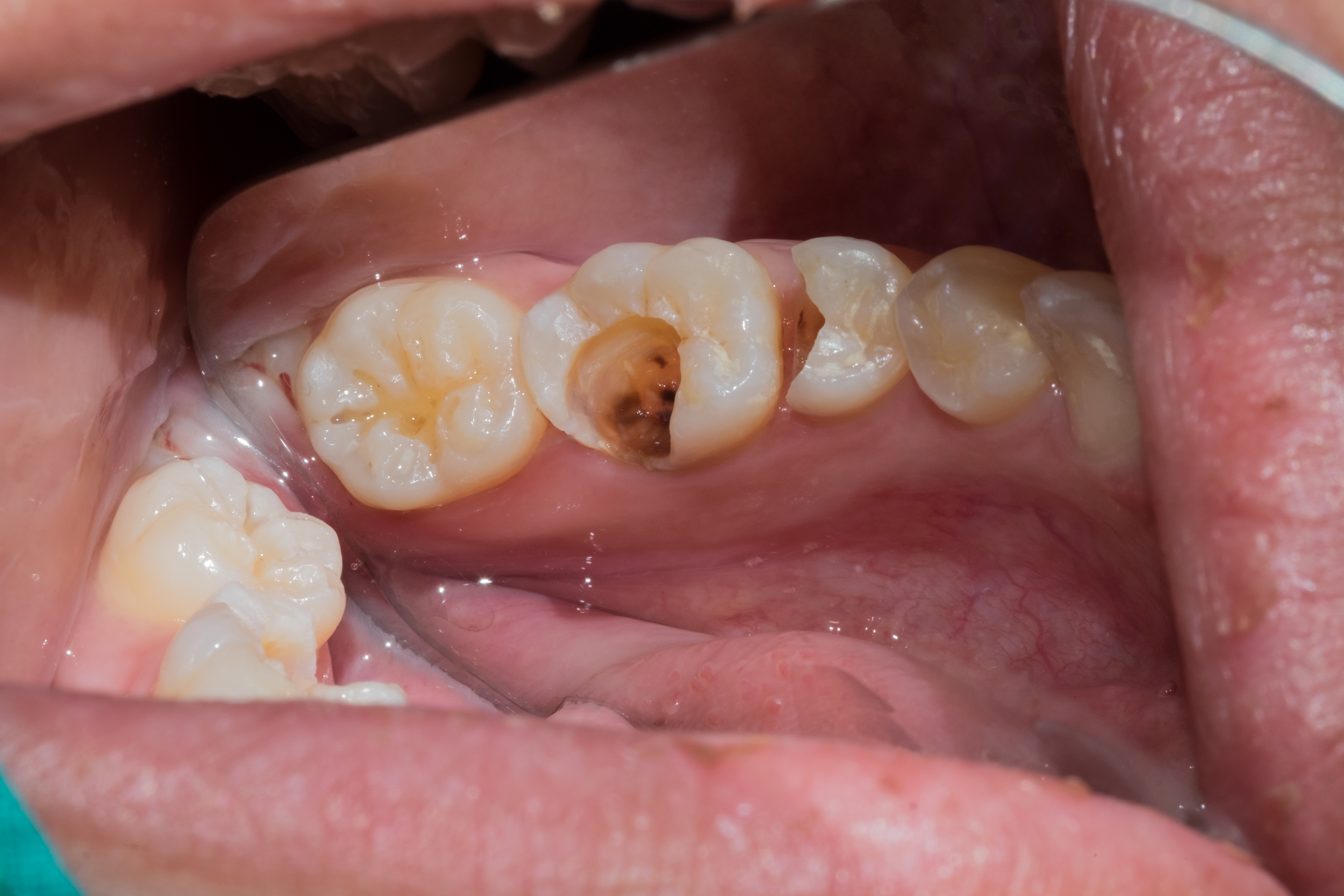 Dental Fillings and its Lifespan