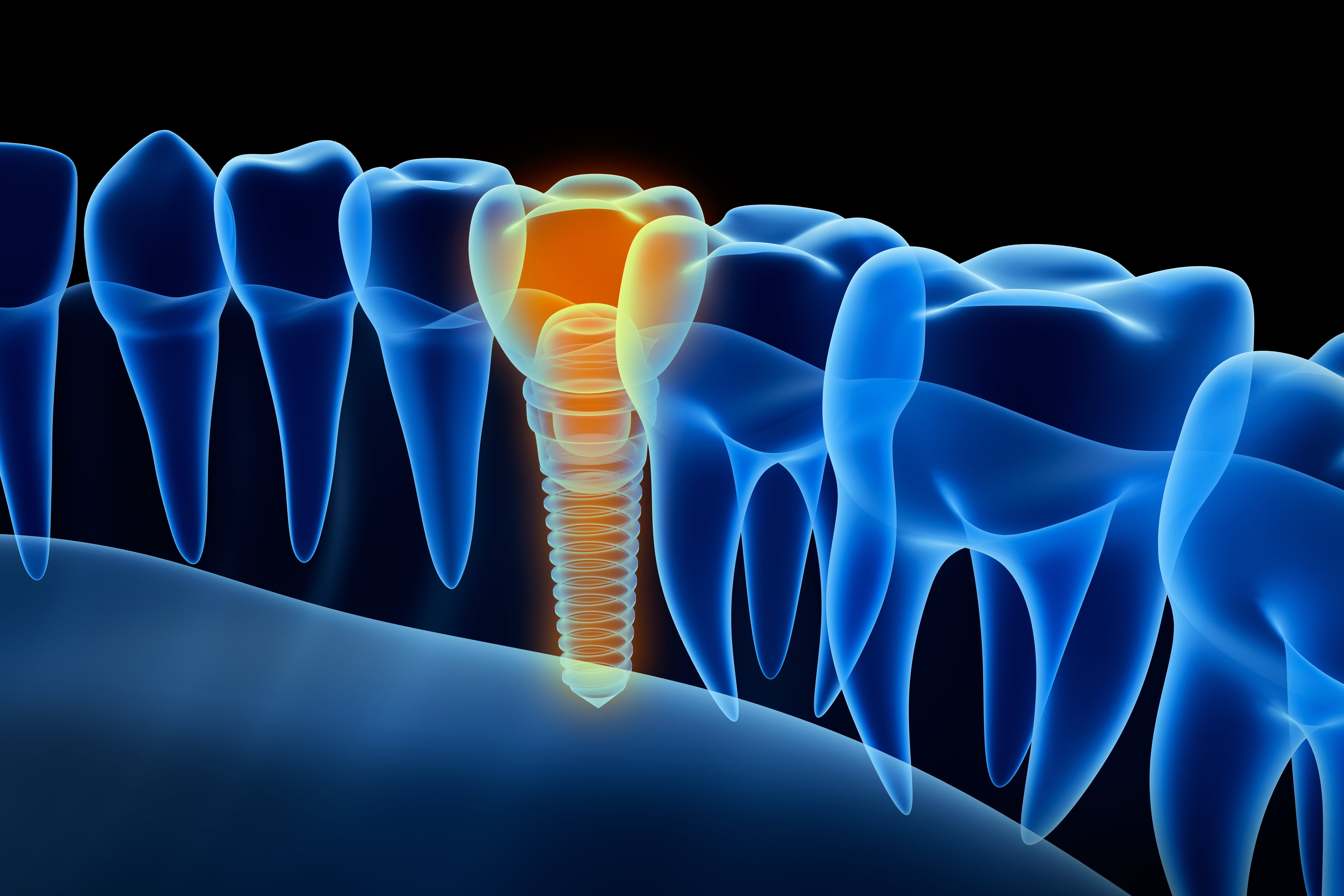 Dental Implant Surgery inserts