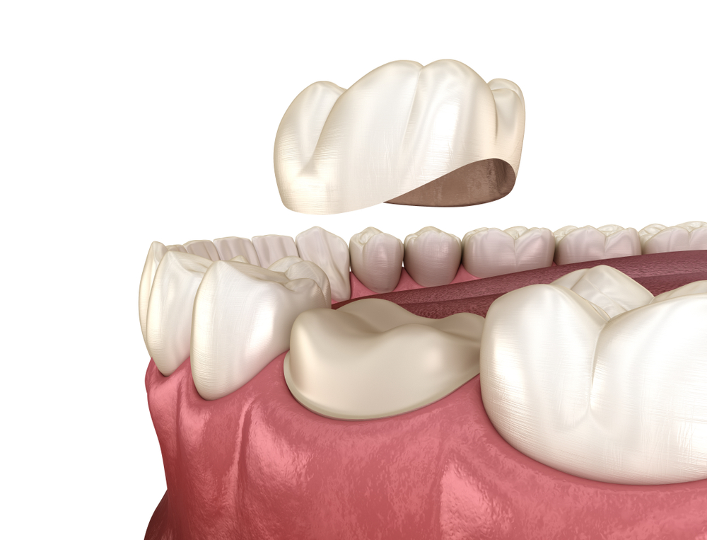 Dental Tooth Cap Repair