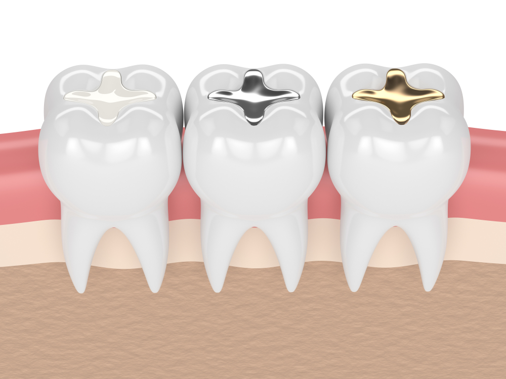 types of dental fillings