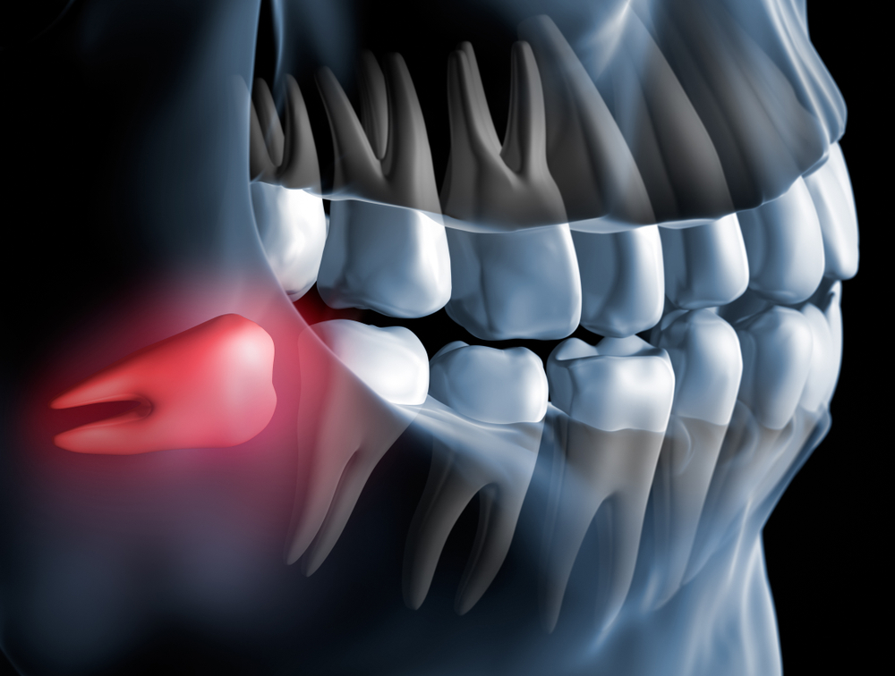 upper wisdom tooth extraction