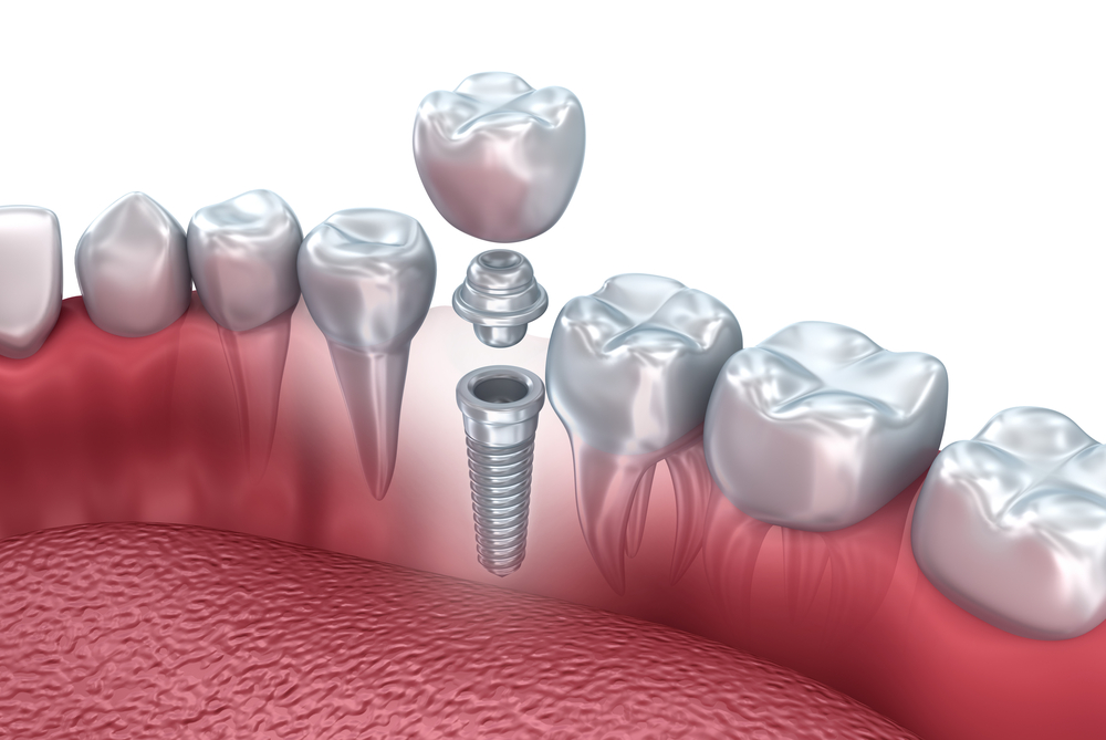 Dental Implants Work Like Your Real Teeth