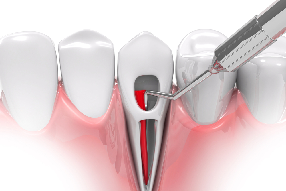 Benefits Of Root Canal